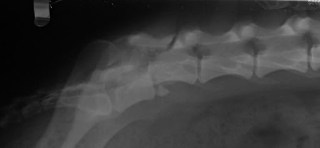 Πλάγια ακτινογραφία οσφυϊκής μοίρας σπονδυλικής στήλης: εξάρθρημα σπονδύλων