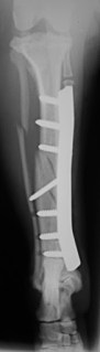 Ακτινογραφία κνήμης σκύλου αμέσως μετά την οστεοσύνθεση με μεταλλική πλάκα  και κοχλίες