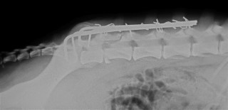 Πλάγια ακτινογραφία σπονδυλικής στήλης μετά τη χειρουργική ανάταξη εξαρθρήματος