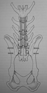 Τροποποιημένη τμηματική νωτιαία σταθεροποίηση