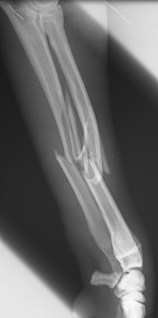 Πλάγια ακτινογραφία αντιβραχίου σκύλου: συντριπτικό κάταγμα