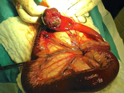 εντεροτομή